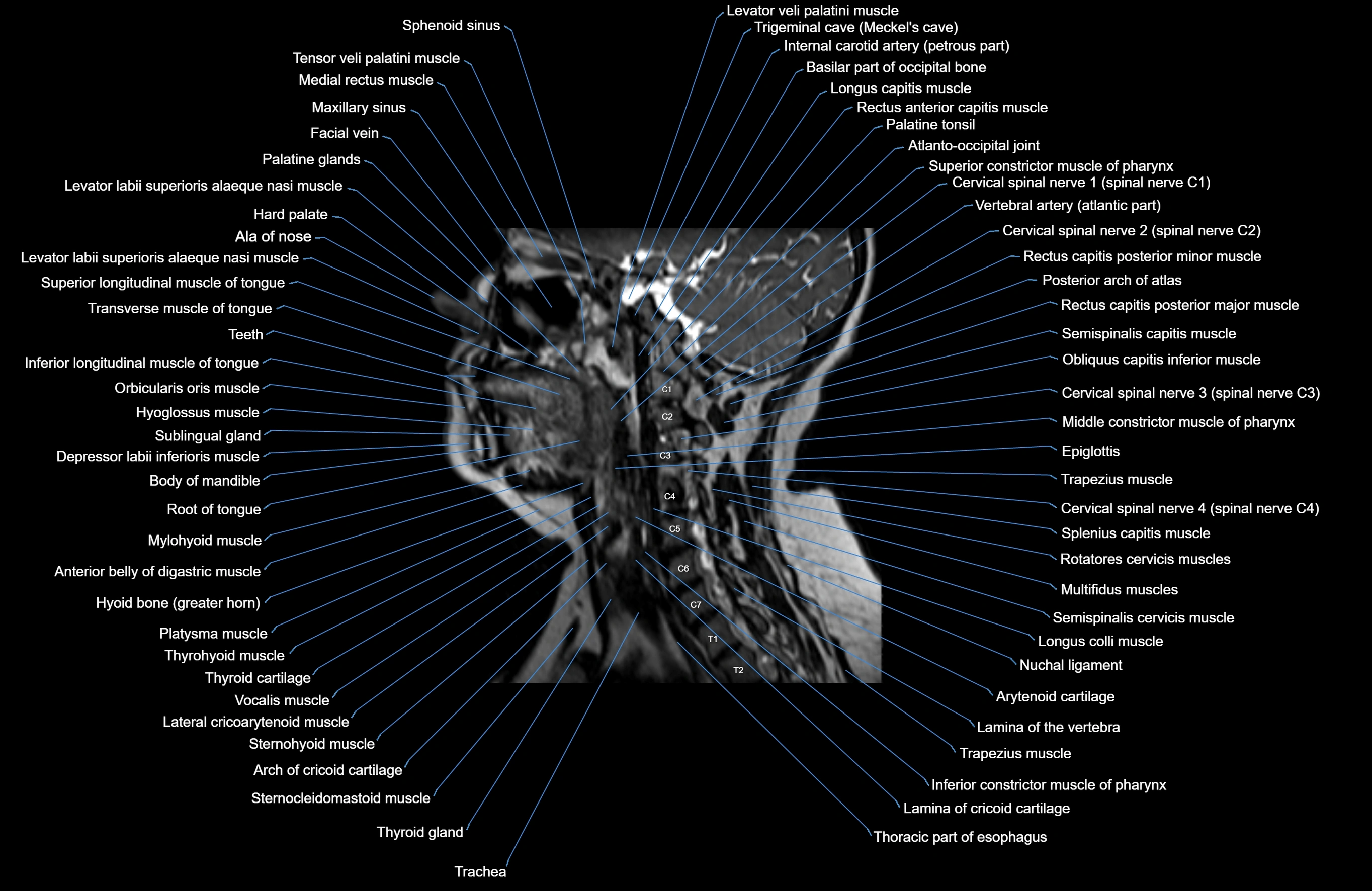 Neck MRI sagittal cross sectional anatomy 3D 1mm 3T radiology  image-img-00001-00011.webp